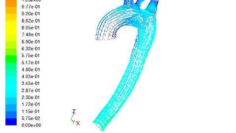 FSI simulation of aortic arch
