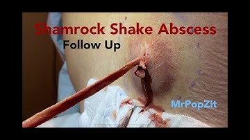 Shamrock Shake Abscess follow up! 48 hours, 1 week, and 3 weeks. Packing removed and additional I+D