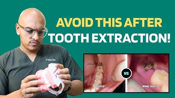 Dry Socket Pain After Tooth Extraction? How to Avoid the Pain (Dentist Explains)