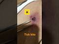 Best way to extract tick 🕷️ #tick#dermatology#bestdermatologist#like#tickbornedisease #extraction