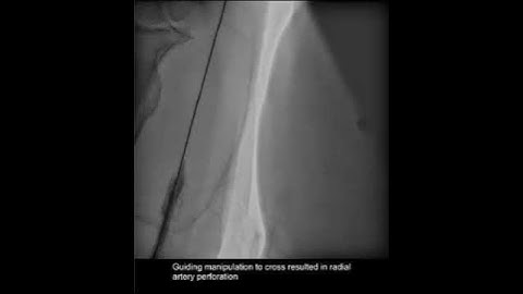 radial artery spasm-  mother in child technique to pass the guiding catheter