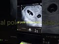 pregnancy ultrasound # triplet# #baby # satna