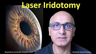 Laser Iridotomy the works,  Mahesh Ramchandani explores all about laser for angle closure glaucoma