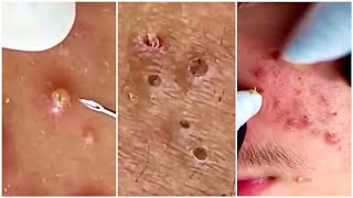 Extremely satisfying blackheads exfoliation, for blackheads and pimples TikTok compilation : pt. 5 :
