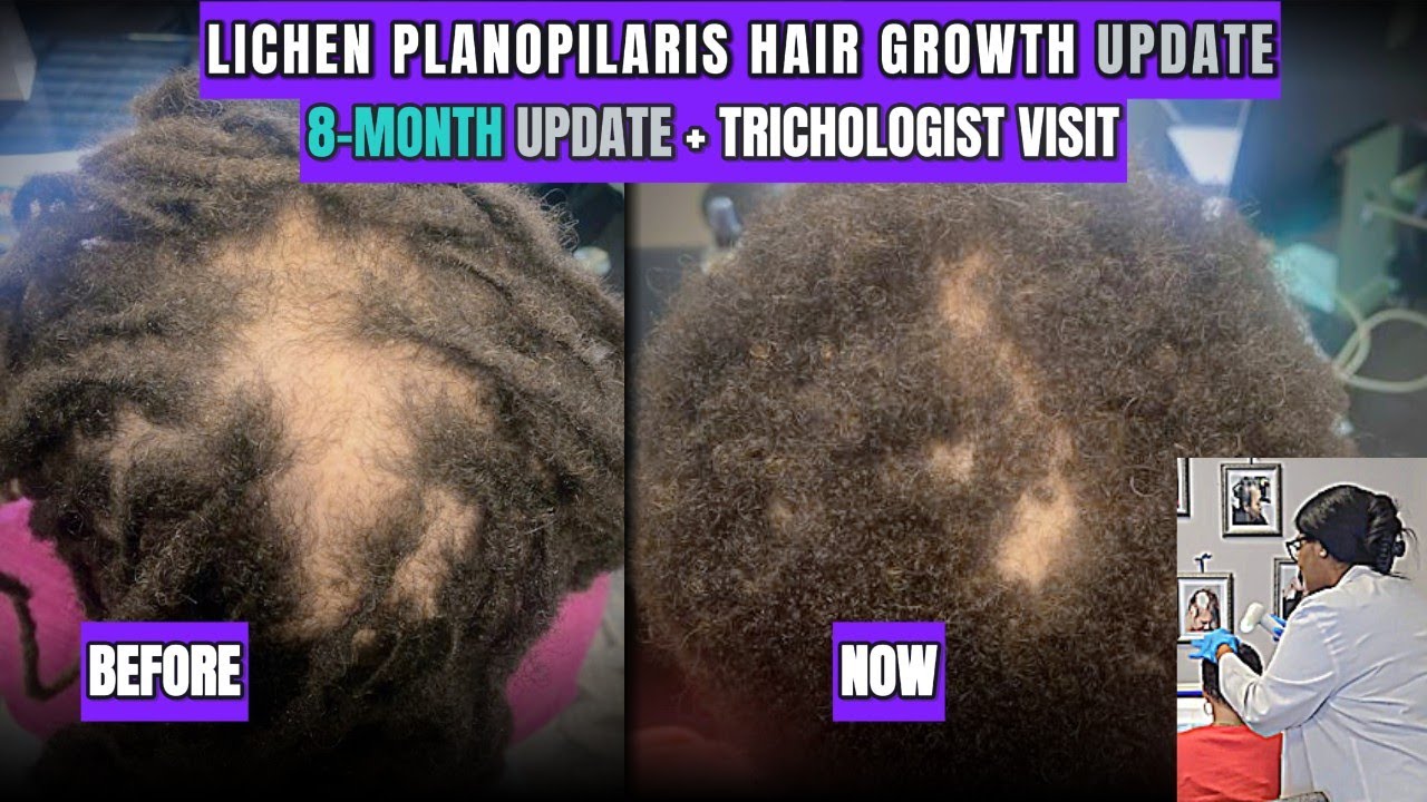 8-Month Hair Growth Update | Lichen Planopilaris Progress & Trichologist Visit