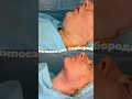 Липосакция подбородка! Всего 20 минут и красивый “угол молодости” ваш🔥  #липосакцияподбородка