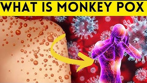 Understanding Mpox(monkeypox) what you need to know #mpox #monkeypoxvaccine