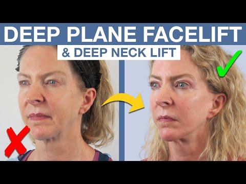 She Looks 20 Years Younger?! Deep Plane Facelift Before & After