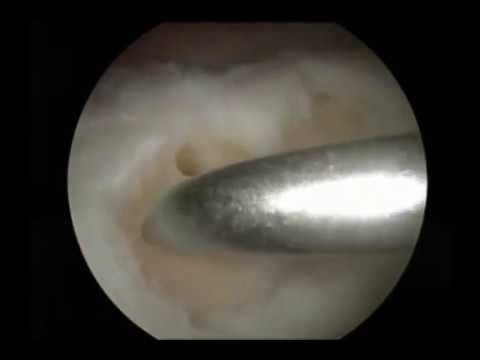 Microfracture Procedure for Knee Cartilage Injury