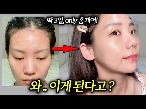 겨울만 되면 ‘이마 좁쌀’ 폭발? 3일 집중 10분 루틴 (세안법,스킨케어,생활습관,영양제)