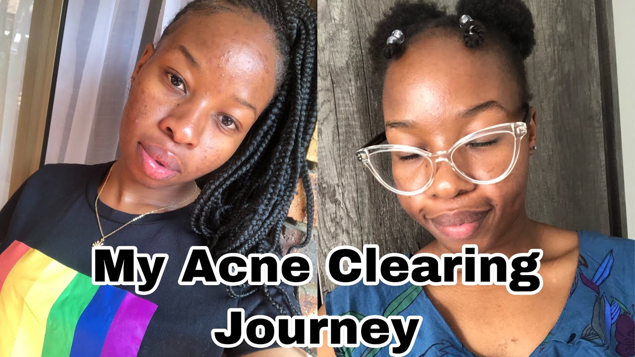 My Acne Journey- How I cleared my acne | Acne Treatment | South African ...