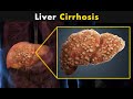 What Happens In Liver Cirrhosis? | Symptoms, Causes And Treatment