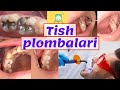 Tish plombalari ichida eng yaxshisi? Тиш пломбалари ичида энг яхшиси?