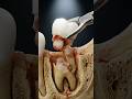 This Wisdom Tooth Was Buried Deep Inside 😨🦷 Full Surgery Process #dentalcare #teethdecay #dentist