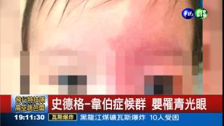 一月嬰罹患青光眼 罕病引發