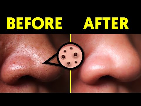 This Will Remove Your Blackheads in 24 Hours