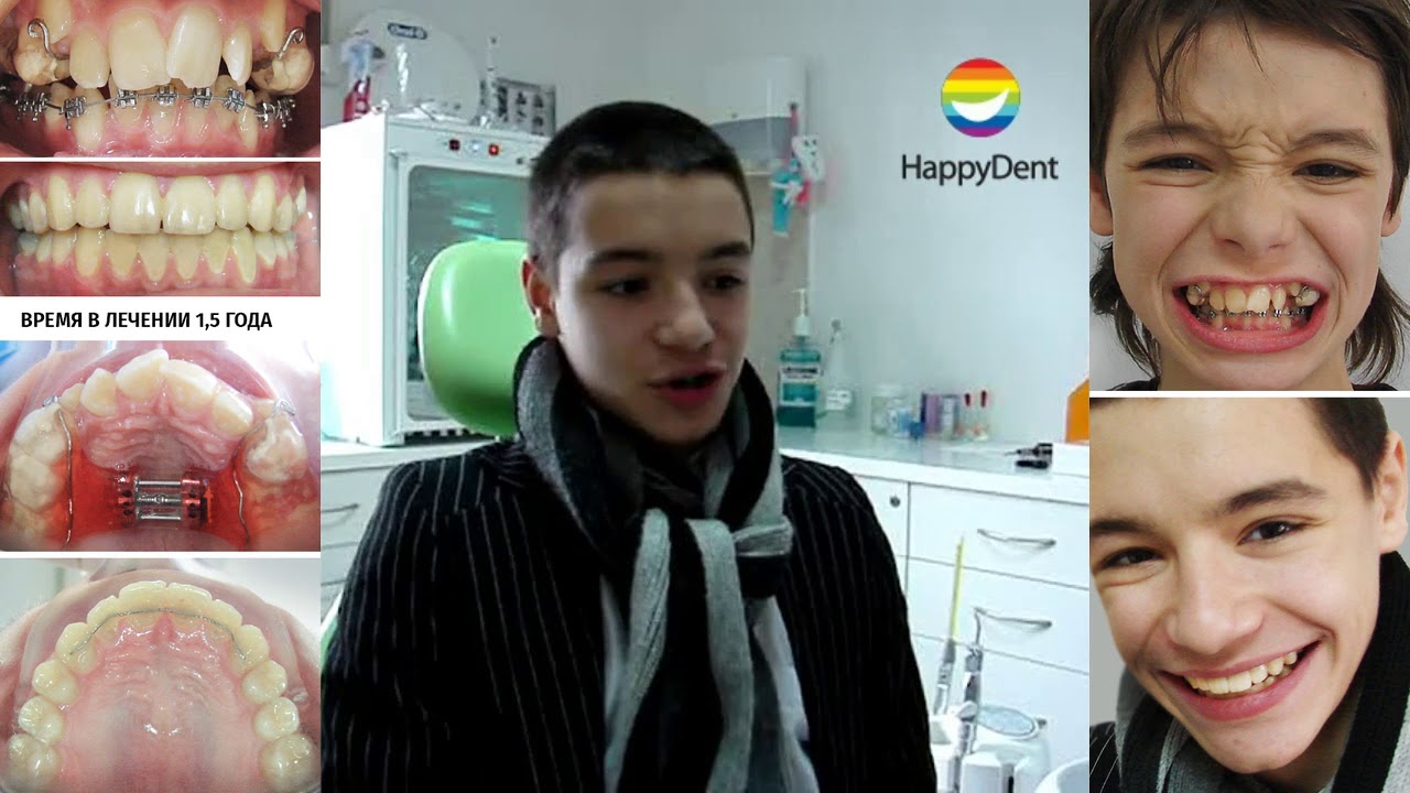 За это никто не брался!!! Макродентия. Брекеты МПД Киев Хеппидент - YouTube