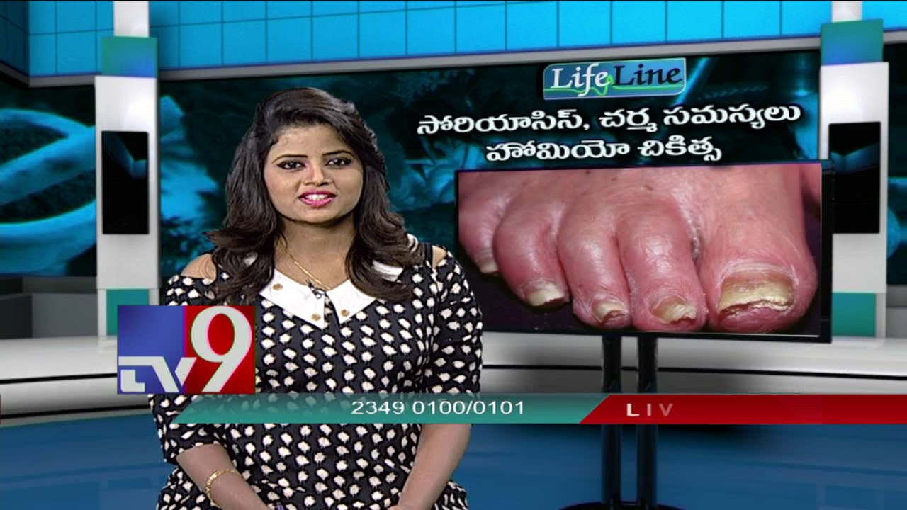 Psoriasis, skin problems || Homeopathic treatment || Lifeline - TV9
