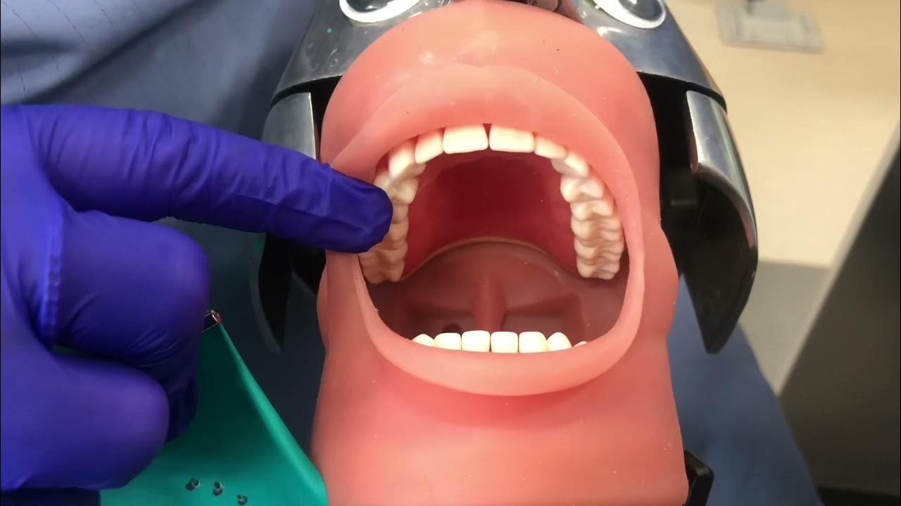Anterior Rubber Dam placement & removal YouTube
