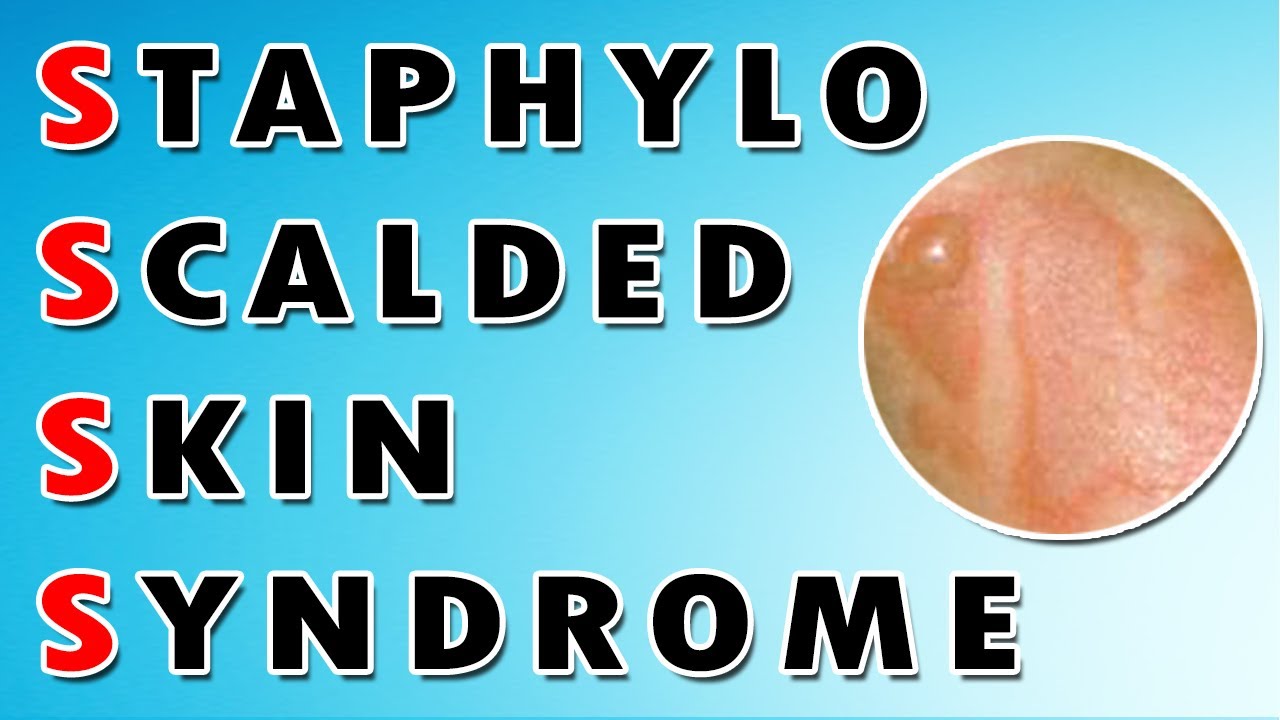 Staphylococcal Scalded Skin Syndrome YouTube