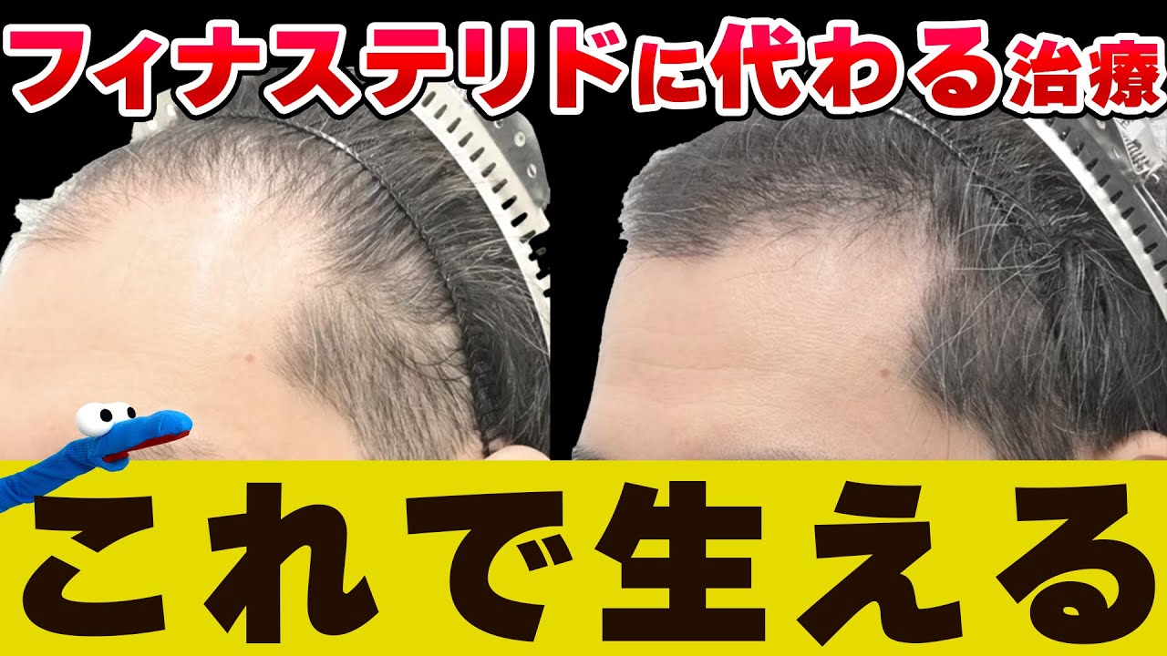 【AGA治療薬】フィナステリドから卒業！たったの3ヶ月で生える話題の治療があるらしい！？