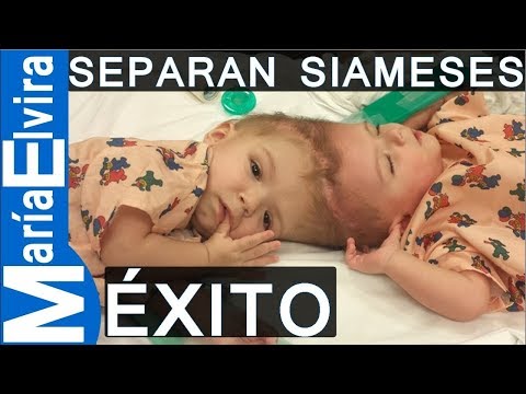 Vídeo: Separación Exitosa De Gemelos Siameses En China - Vista Alternativa