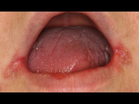 Video: 3 Cara Mudah Menyembuhkan Angular Cheilitis