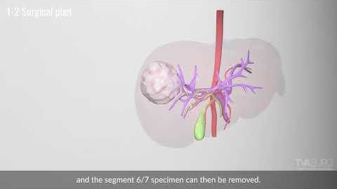 Laparoscopic pediatric right posterior sector resection