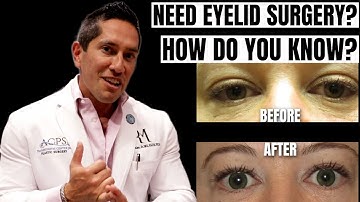 Signs You Need Eyelid Surgery: How to Determine if Blepharoplasty is Right for You