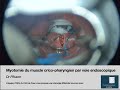 Myotomie du muscle cricopharyngien par voie endoscopique