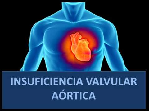 Vídeo: Insuficiencia De La Válvula Aórtica - Tratamiento, Grado