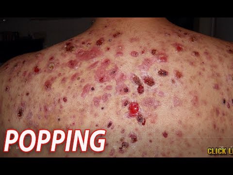 Severe Back Acne!  What is Bacne?
