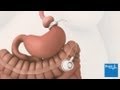 How gastric banding surgery is carried out