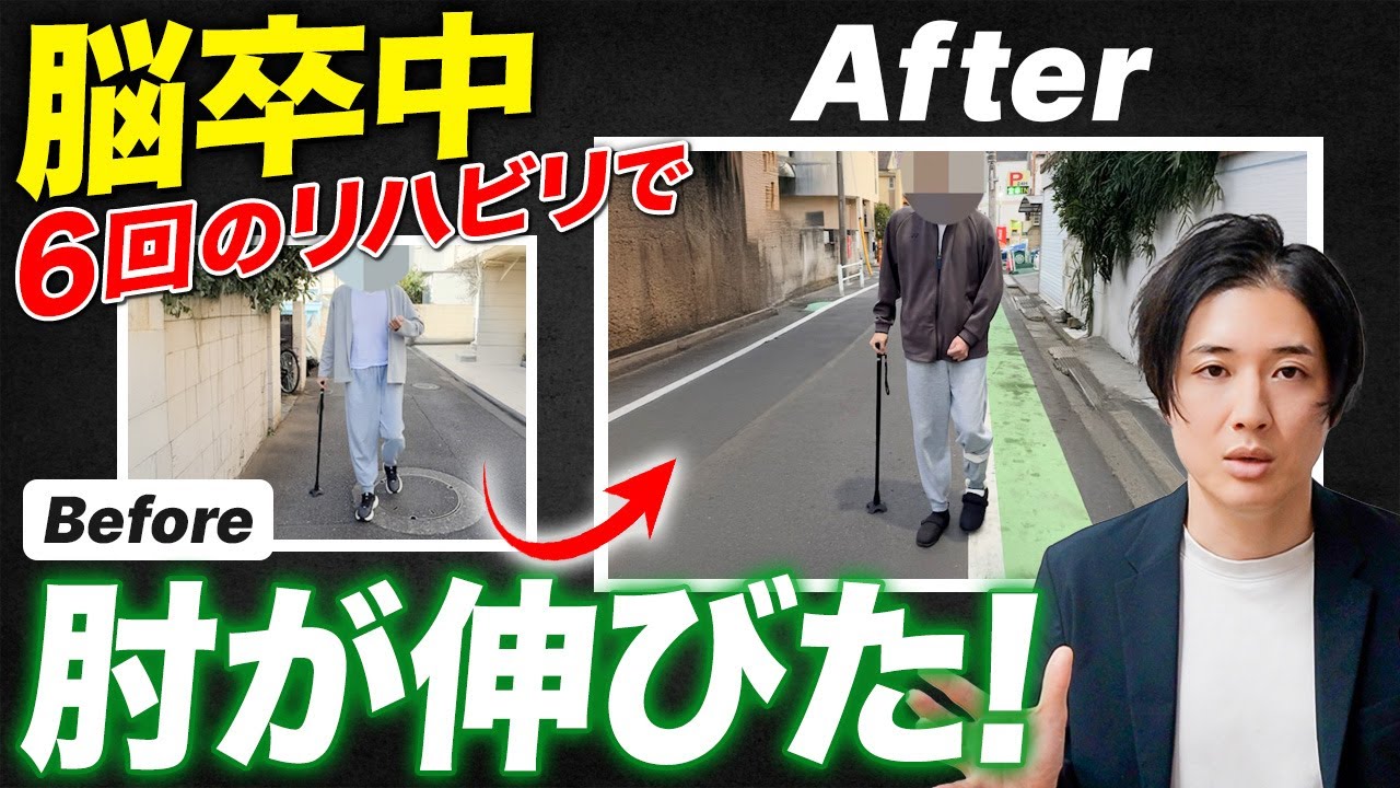 歩いているときの“肘の曲がり”、上肢リハビリ6回で変わった理由｜脳卒中発症1年