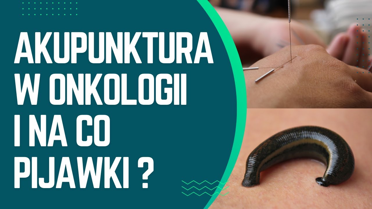 Akupunktura i pijawki, czyli medycyna chińska