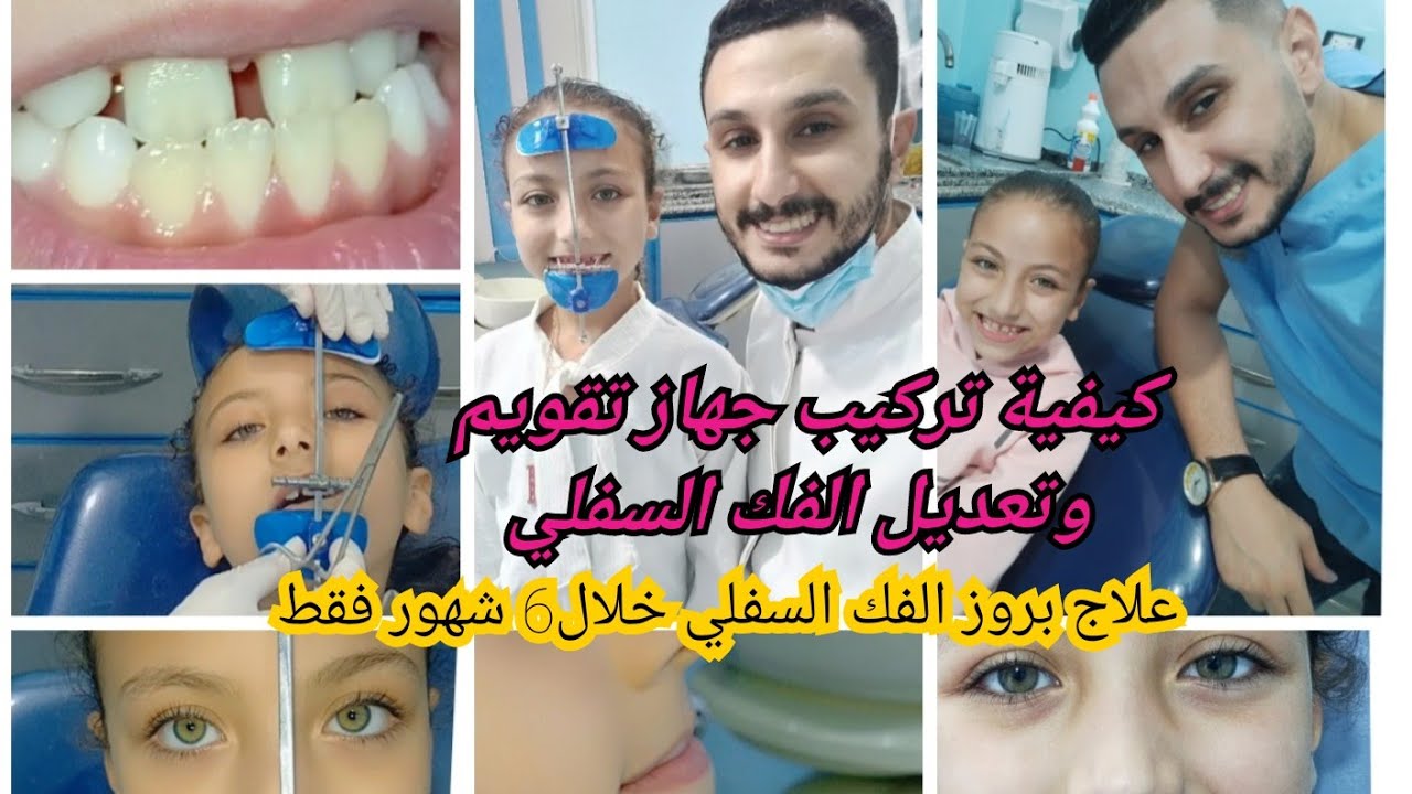 جهاز تقويم الاسنان لتعديل بروز الفك السفلي||How an orthodontic face mask is adapted to fit correctly