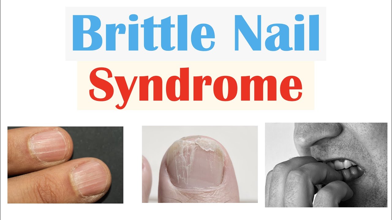 Brittle Nail Syndrome | Causes, Signs & Symptoms, Diagnosis, Treatment, Supplements