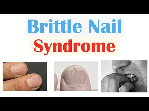 Video: Vad är onychorrhexis på nageln?