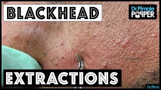 A Blackhead Extractor & Tweezer Dance