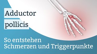 Adductor pollicis Schmerzen, Triggerpunkte und deren Aktivierung