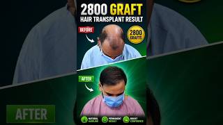 Hair Transplant Result & Patient Experience #hairtransformation
