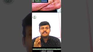 psoriasis treatment in tamil | psoriasis treatment | maruthuva kurippu