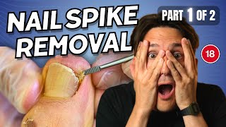 Ingrown Toenail Spike Removal part 1 of 2
