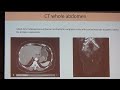 17 Case Discussion II Malignancy Case