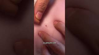 Thousands of Tiny Blackheads Removed 🐱 | Sphynx Cat Deep Cleaning #Shorts