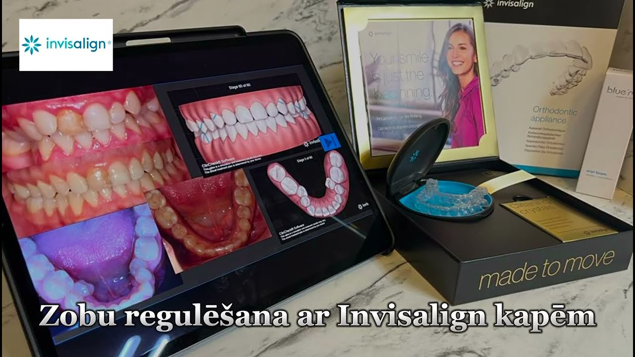 Zobu sakodiena koriģēšana ar INVISALIGN kapēm