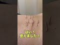 ぎっくり腰と坐骨神経痛を深層筋の鍼灸で回復させてみた#鍼治療 #鍼灸師 #鍼灸治療 #癒し #asmr