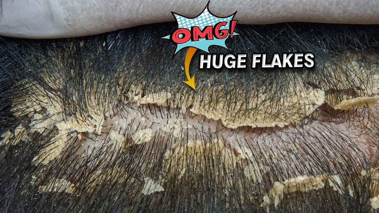Scratching Dandruff Big Flakes Dandruff Removal YouTube