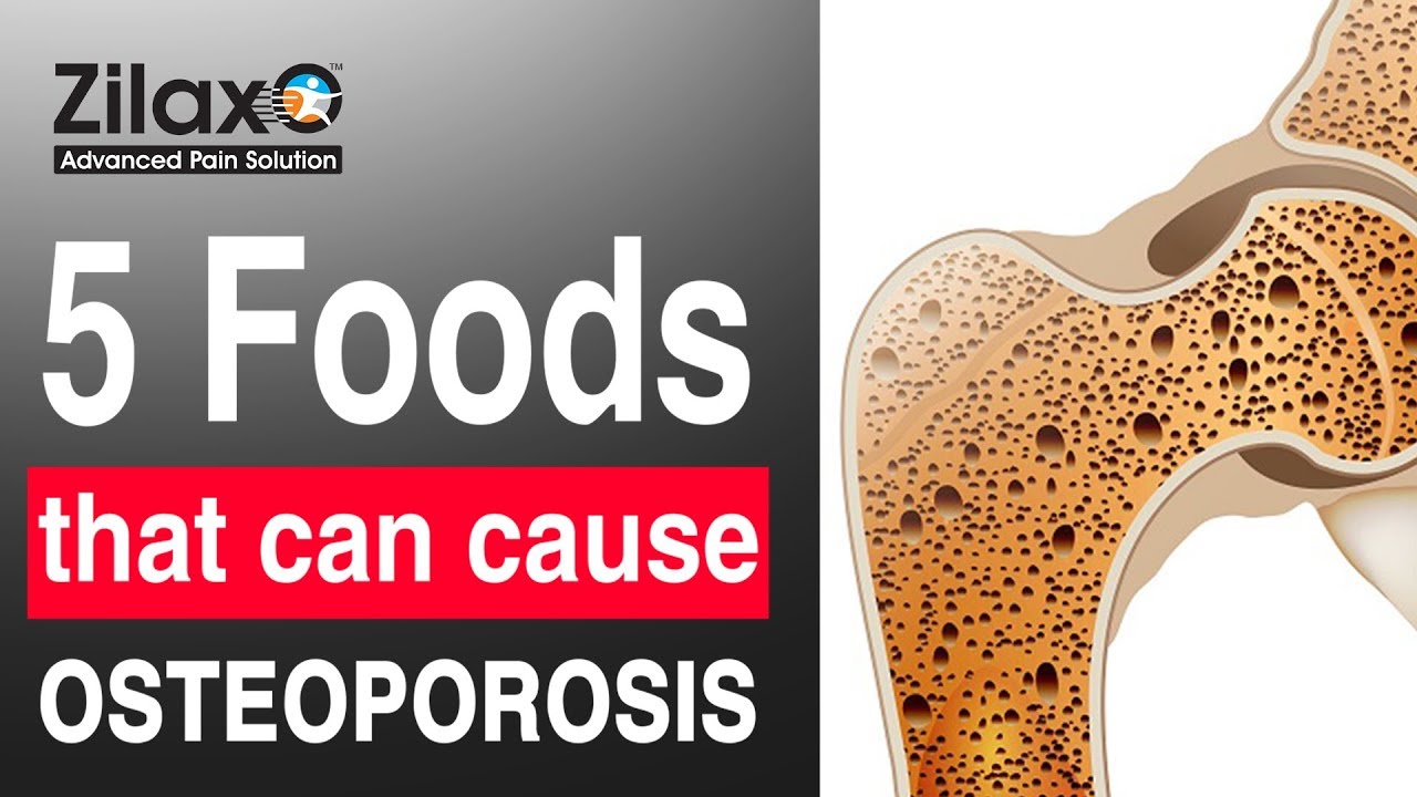5 Foods That Can Cause Osteoporosis Symptoms, Prevention and