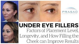 Possible Causes of Lumpiness with Under Eye Fillers, and How Adding Cheek Volume Can Help